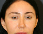 Feel Beautiful - Bratz Blepharoplasty - Before Photo